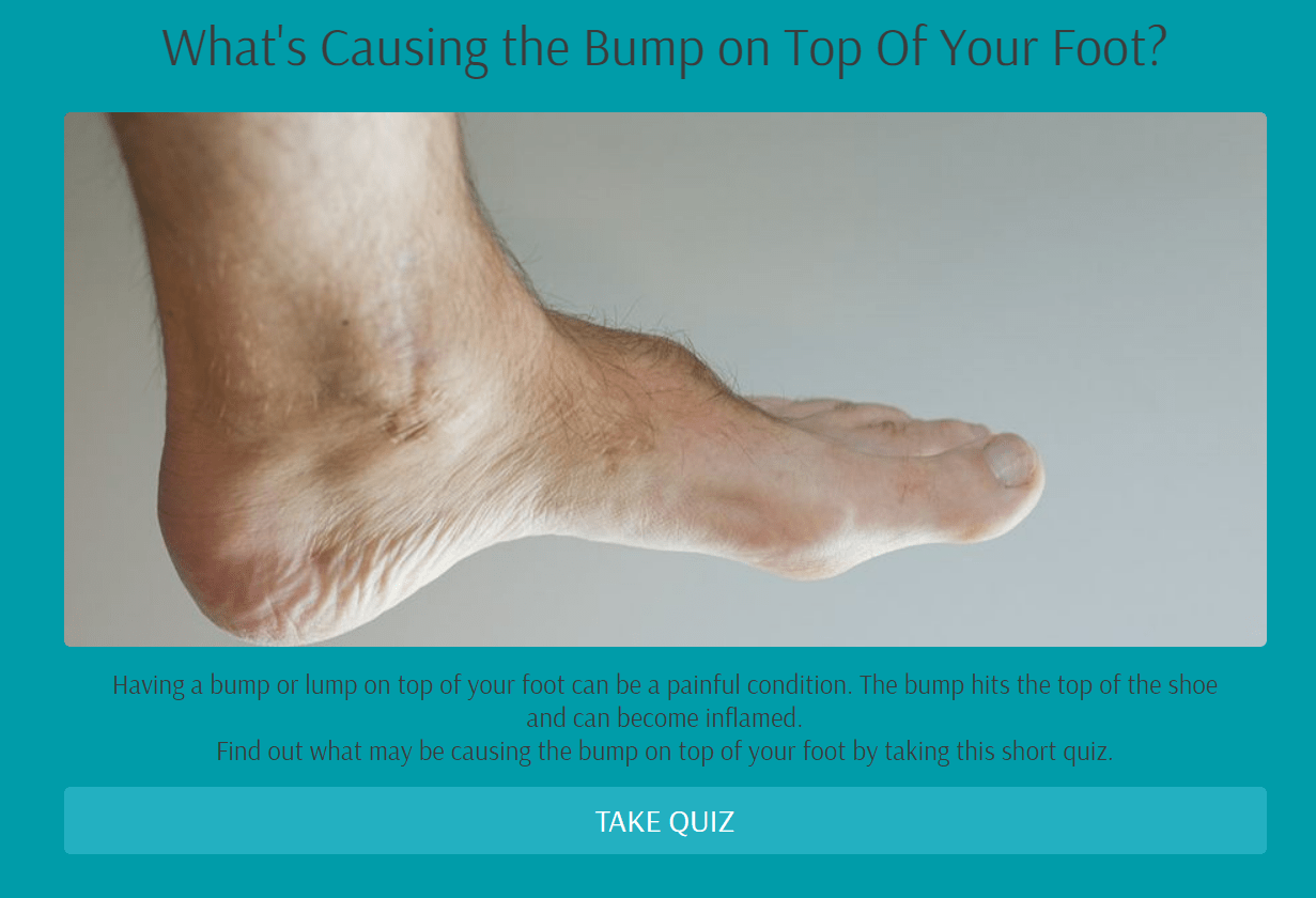 Painful Bump on Top Of Foot Tanglewood Foot Specialists